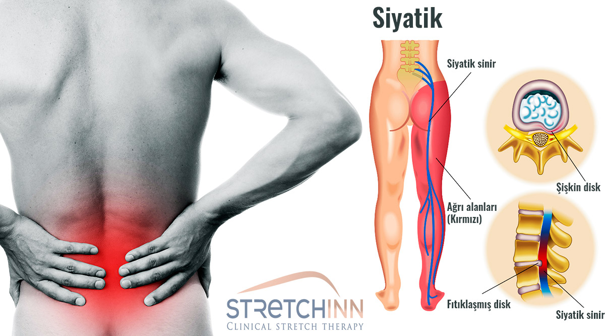 Siyatik Ağrısı Çekenler İçin Stretching